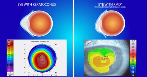 normal cornea decenterion